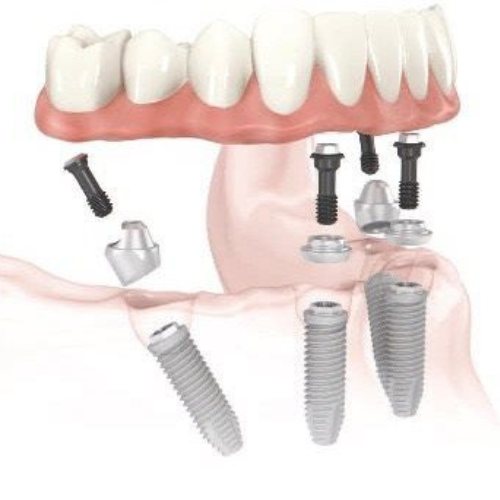 brightsmiledental - IMPLANT Solutions