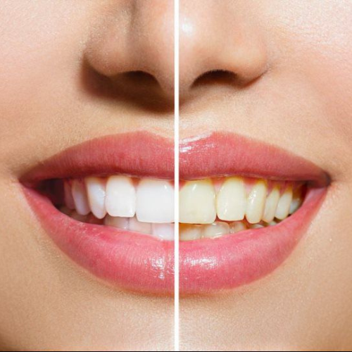 brightsmiledental - services Teeth Whitening